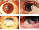 Brief Article On Ocular Manifestations Of Hyperlipidaemia