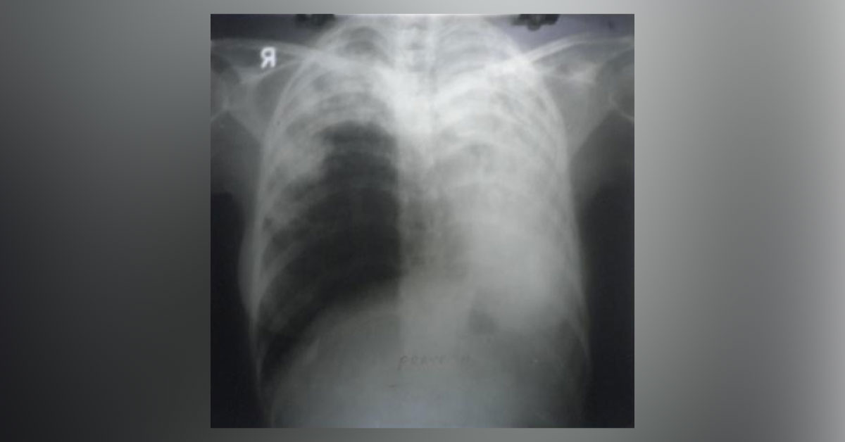 Advanced Pulmonary Tuberculosis