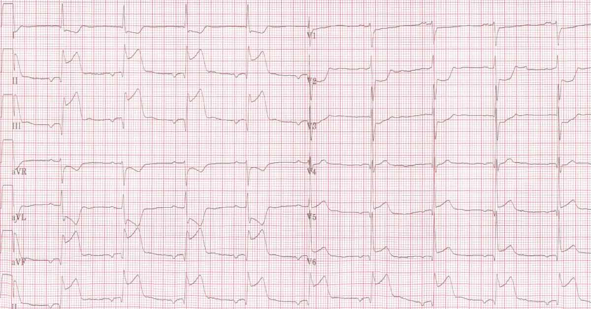 Identify The Cardiac Abnormality