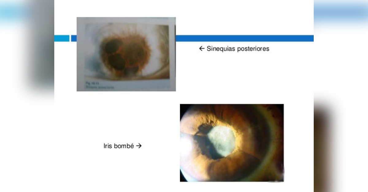 A Brief Review Of Causes Of Dislocation Of Lens