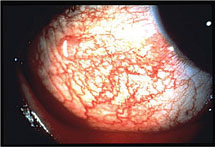 Ocular Side Effects Of Drugs A Brief Review