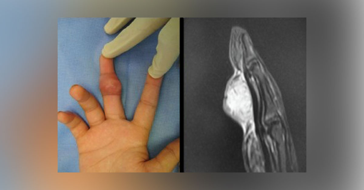 Diagnosis For Growing Mass On Middle Finger