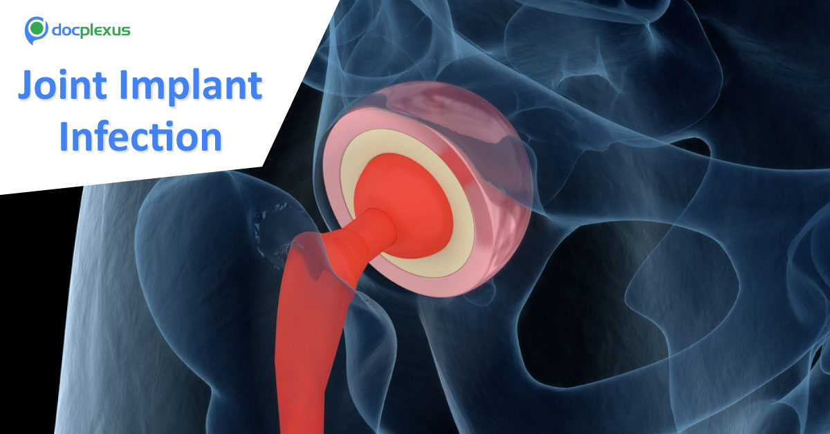 Antibiotic Eluting Polymer Eradicates Joint Implant Infection