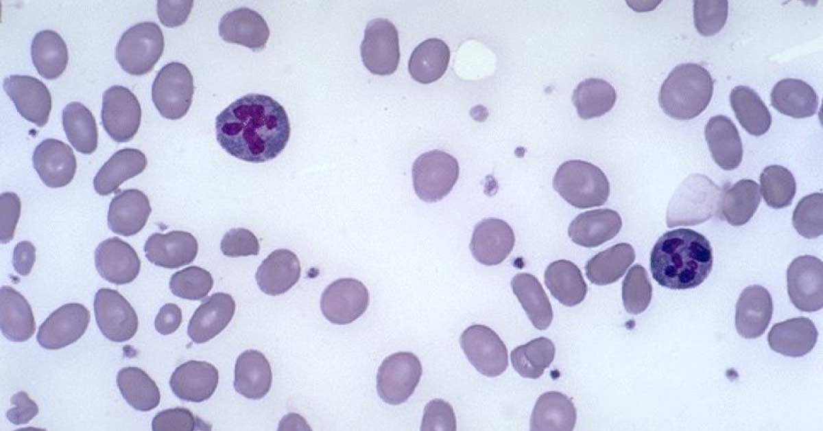 What Does This Blood Smear Represent?