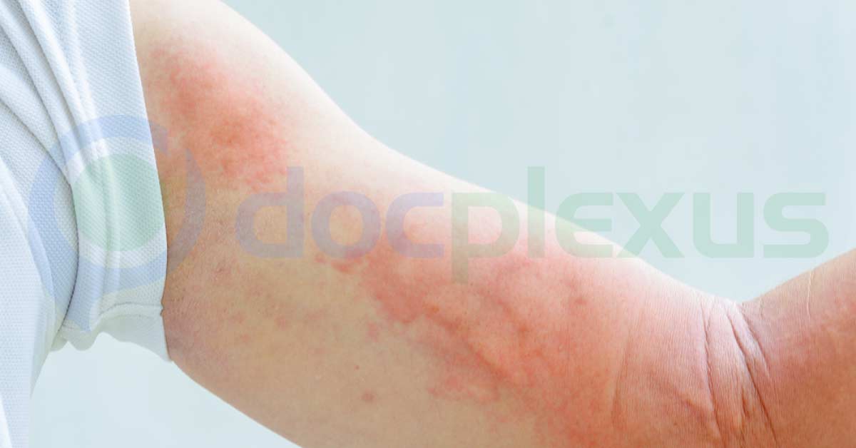 Urticaria Management in Adults and Children