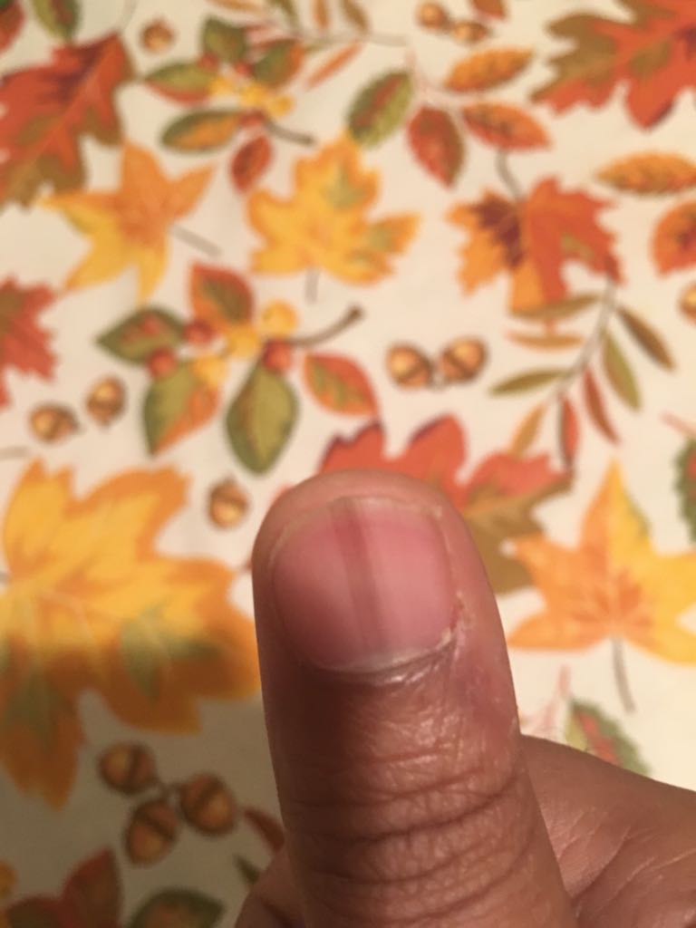 Diagnose The Nail Condition