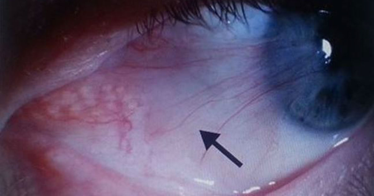 Various Surgical Modalitiesin The Treatment Of Pterygium