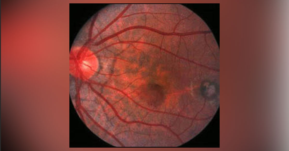 Ocular Manifestations Of Sickle Cell Disease