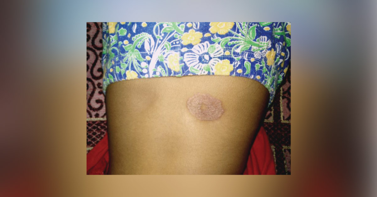 Treatment for the condition