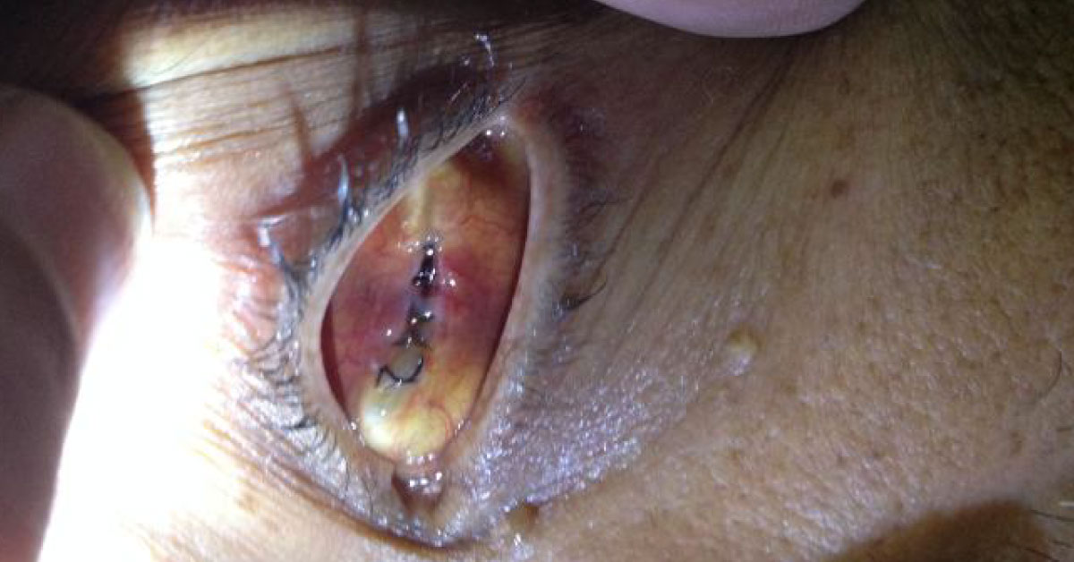 An Interesting And Rare Case Of Choriodal Melanoma