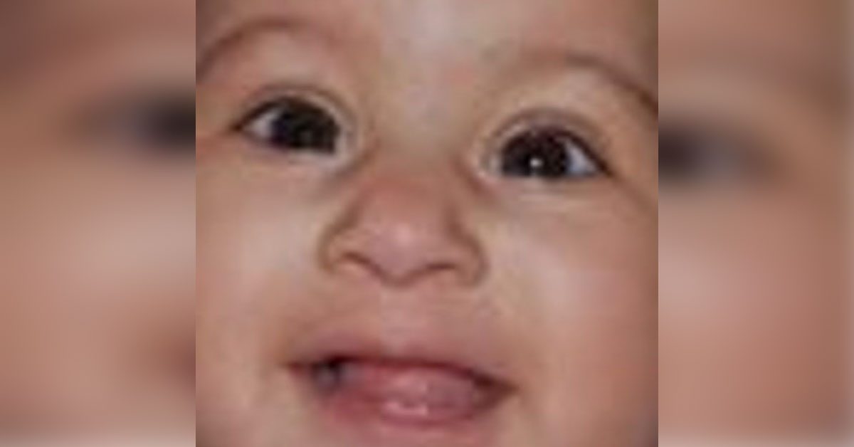 Rare Case Of Bilateral Congenital Corneal Dystrophy With Associated Ant Staphyloma Left Eye