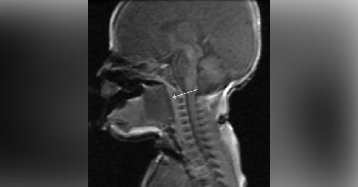 Neonate With Sudden Respiratory Distress