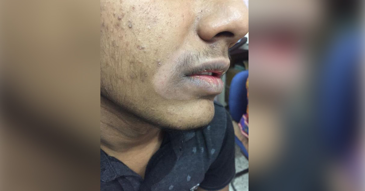 What Is This Skin Problem On Face? 