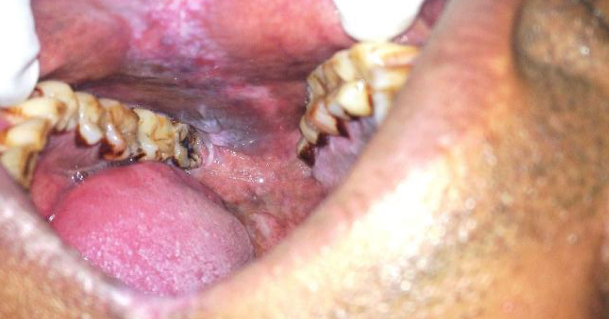 Identify The Lesions