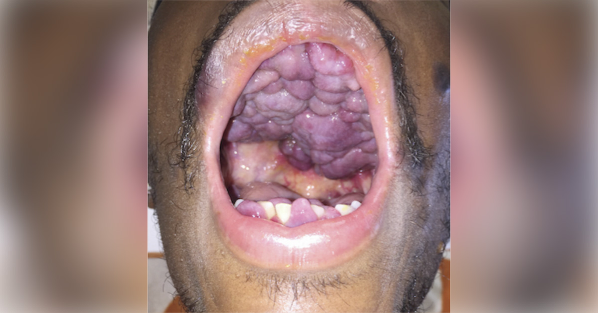 Identify This Oral Condition