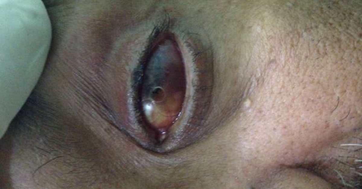 A Brief Review Of Cataract Surgery