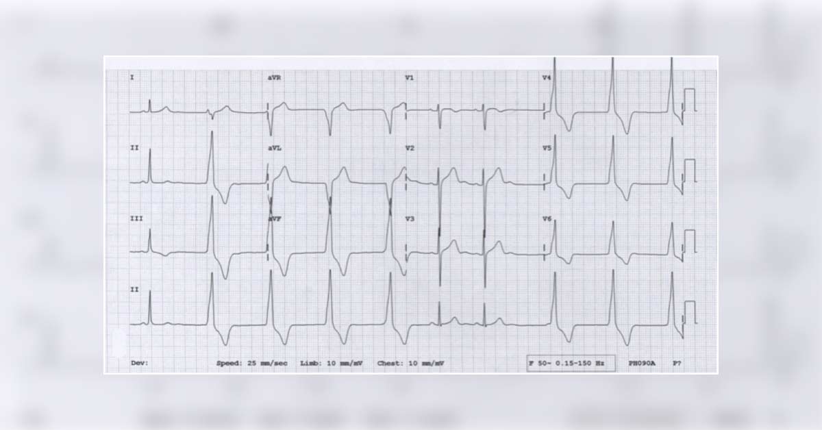 ECG of A Marathon Runner