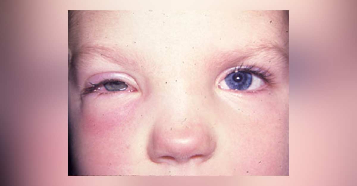 Red Swollen Eyelid