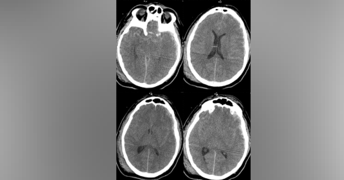 Traumatic Brain Injury In A Road Accident