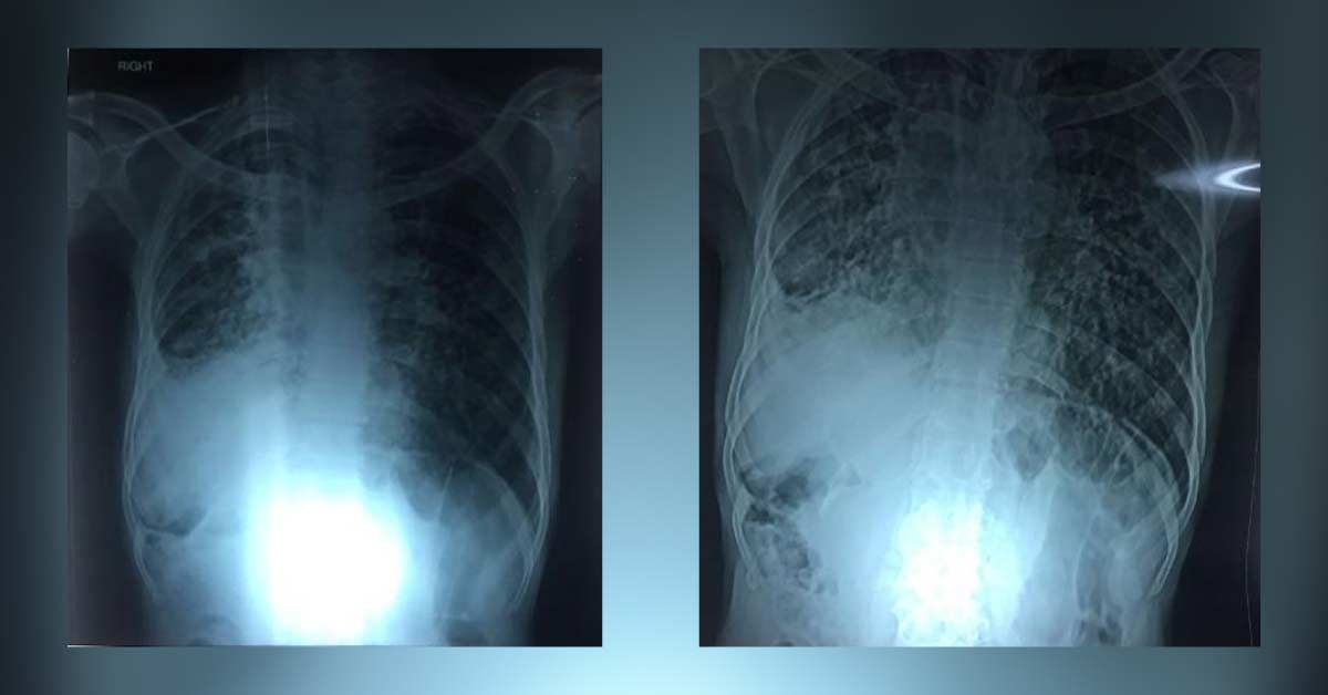 What is the difference between the two xrays? 