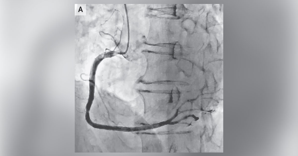 Identify This Cardiac Condition