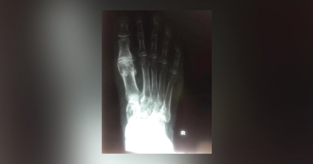 Why Big Toe And 1st Metatarsal Of Rt Foot Are Broader? 