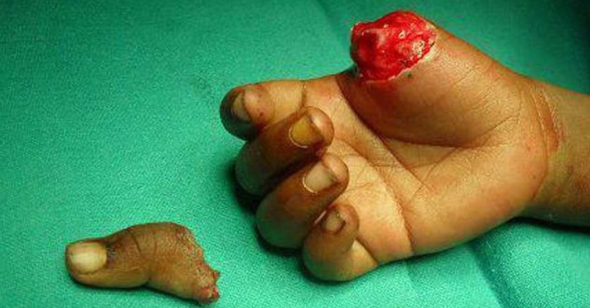 Replantation Or Reunion Of Detached Thumb In 4 Year Old Child