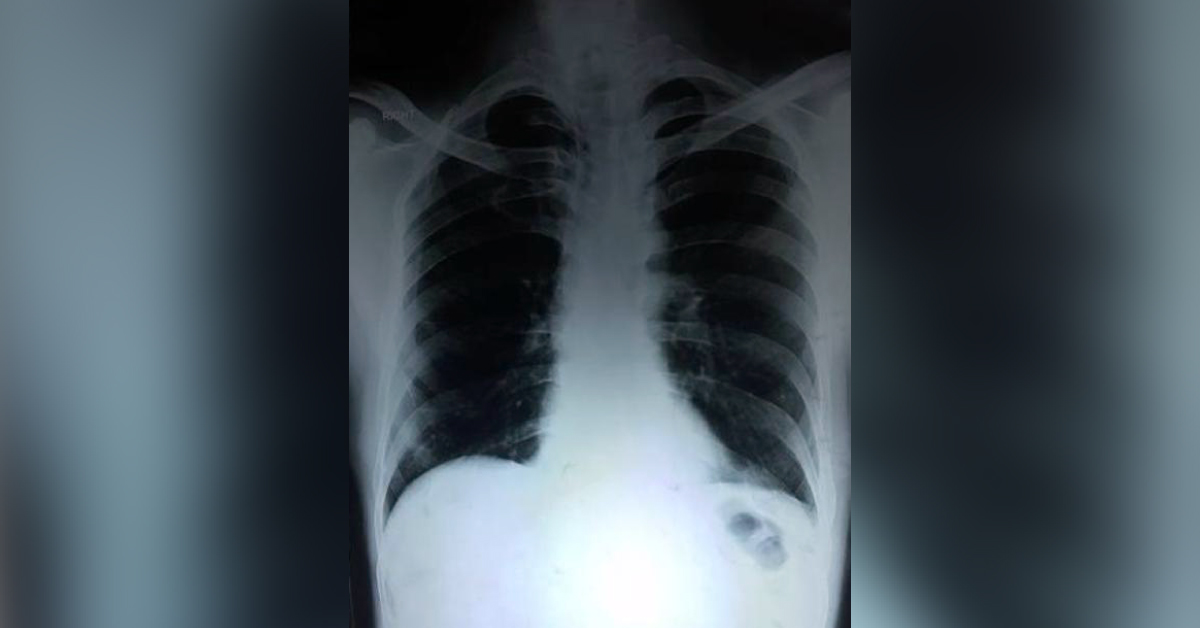 Is It Left Main Bronchus Or Melted Hilar Lymph Node? 