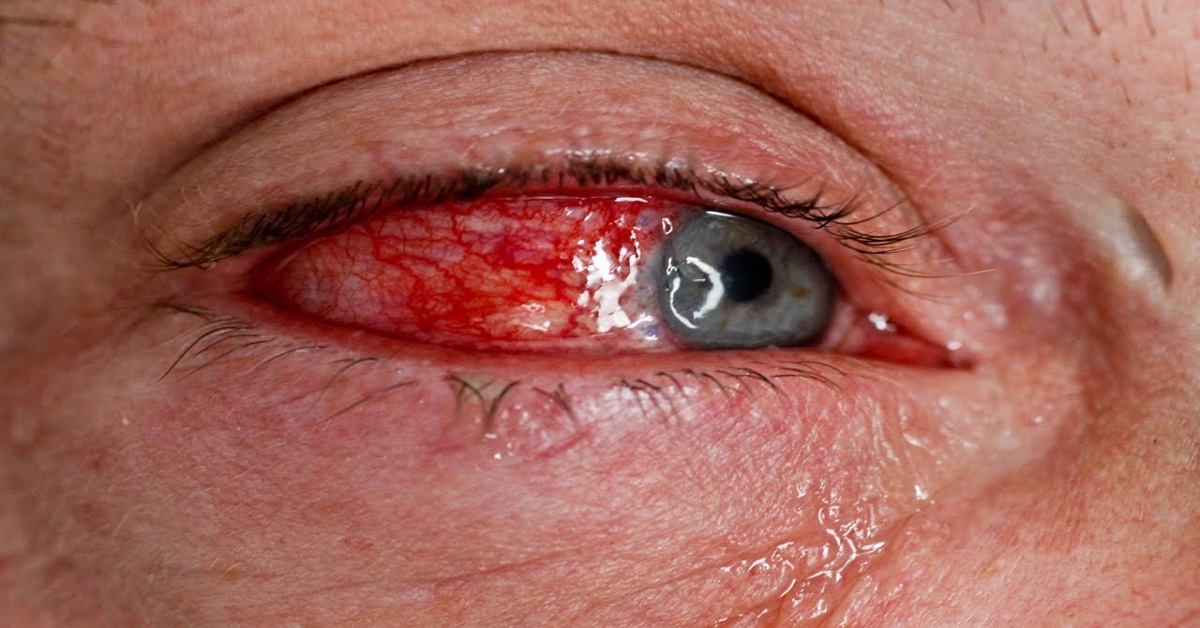 Emergency Treatment For Chemical And Thermal Ocular Burns
