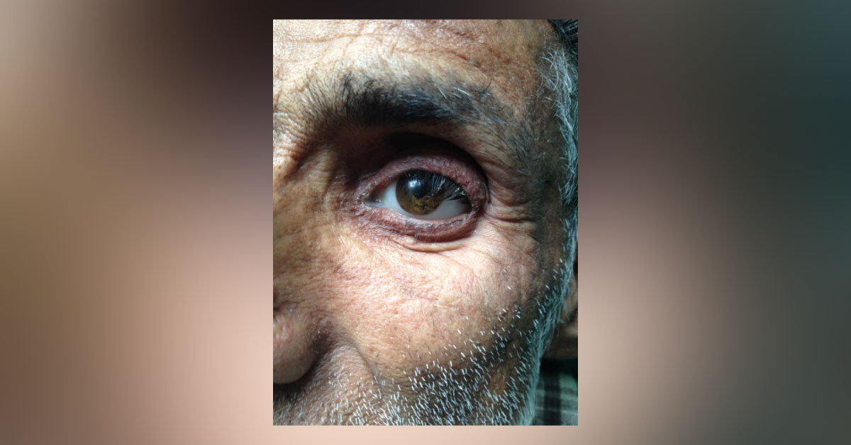 Present Status Of Sympatheic Ophthalmitis