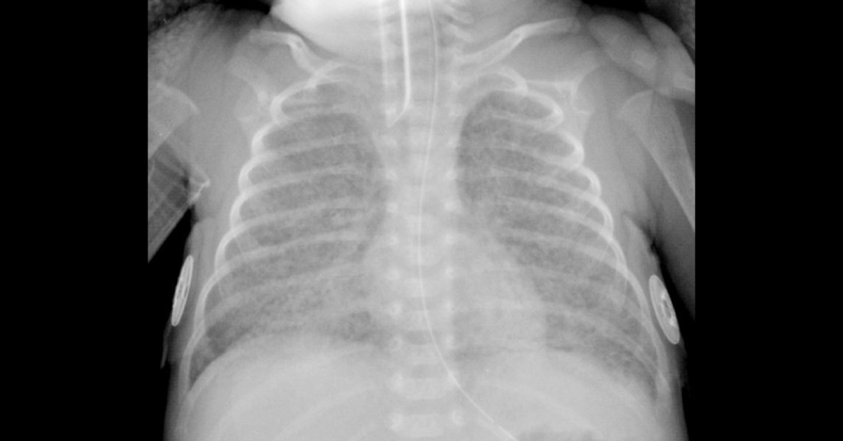 Identify This Pulmonary Condition In A Premature Newborn