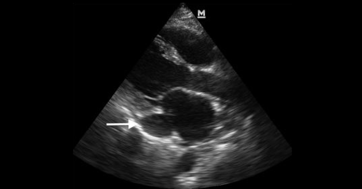 Identify This Cardiac Condition