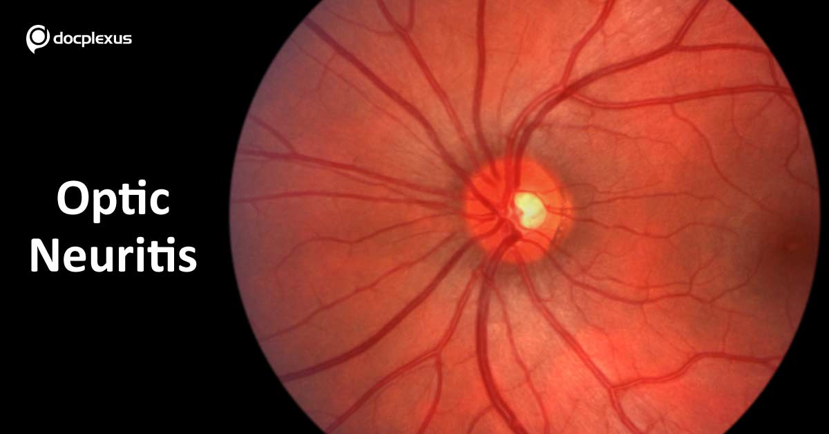 Devic’s Disease, Practice Recommendations for Diagnosis and Management