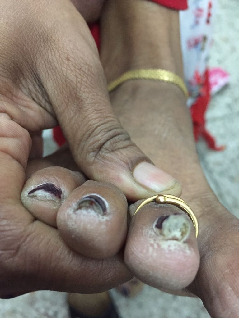 What Is This Nail Problem? 