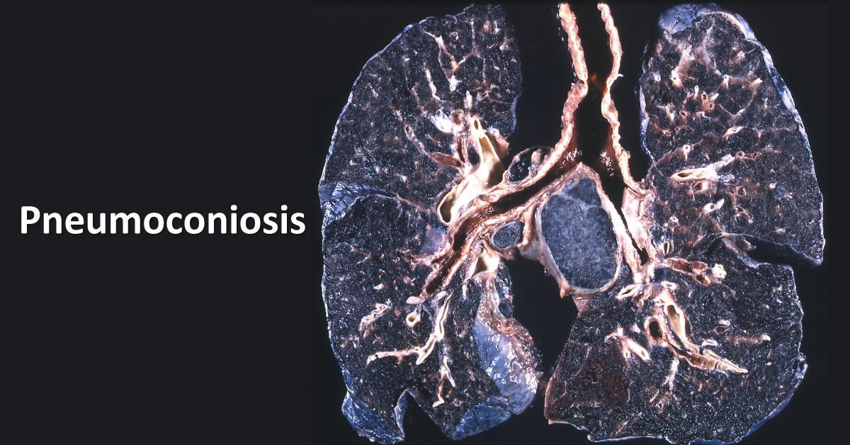 All About Pneumoconiosis!