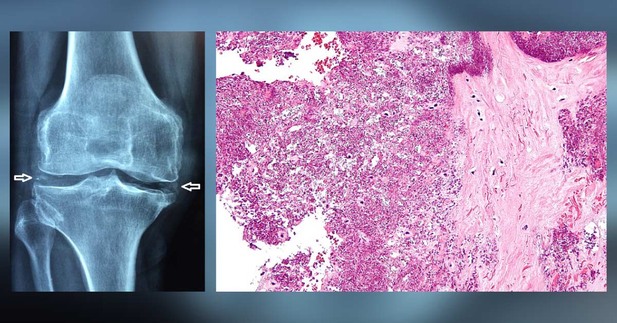 Important Clinical Findings In Calcium Pyrophosphate Crystal Deposition Disease