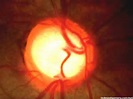 Very Brief Review On Disc Changes In Glaucoma