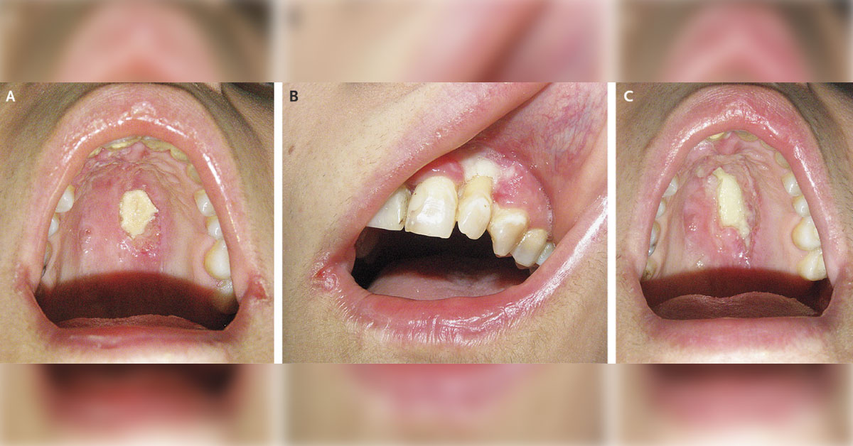 Destructive Ulcerated Lesions