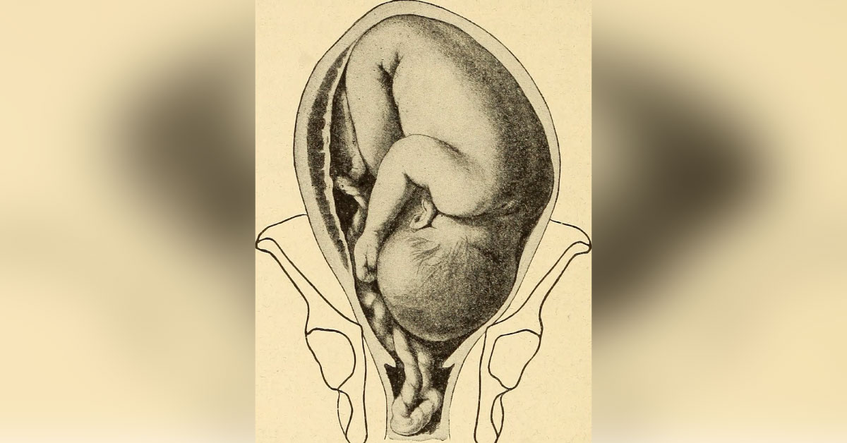 Umbilical Cord Prolapse: RCOG Guidelines