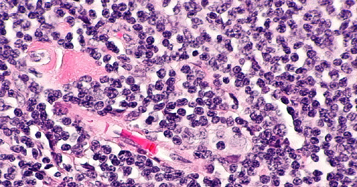 Diagnosing Follicular Lymphoma At Early Stage