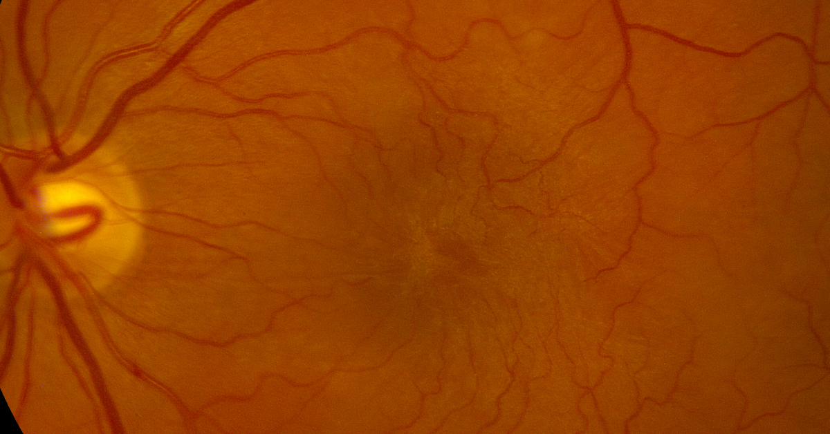 Brief Review Of Macular Disorders