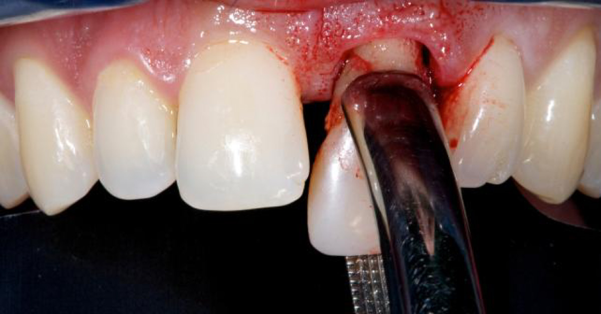 What To Do Following A Tooth Extraction!