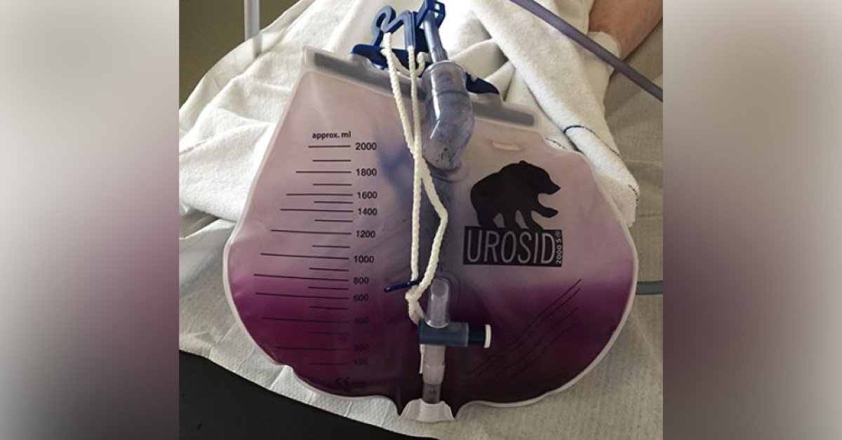 Puzzling Case Of Purple Urine