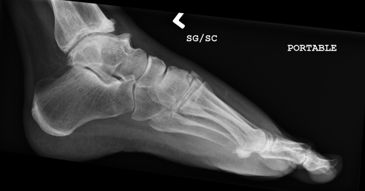 What Is Best Treatment For This Injury?