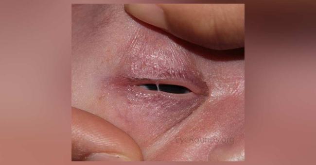 Very Brief Post On Ankyloblepharon