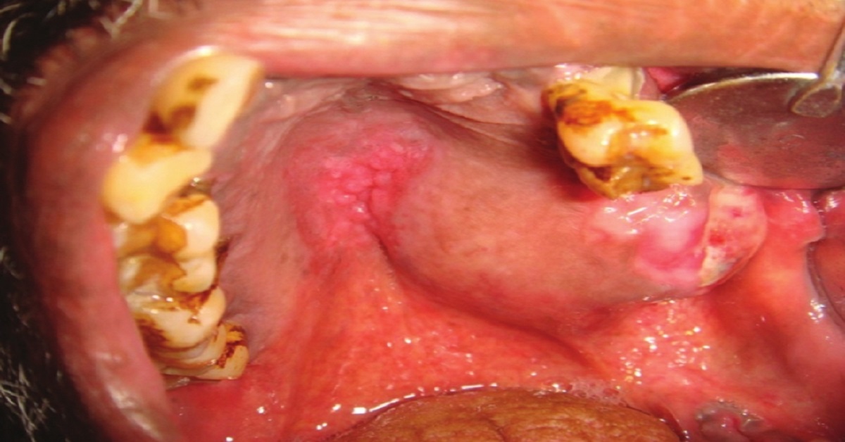 Identify The Oral Condition