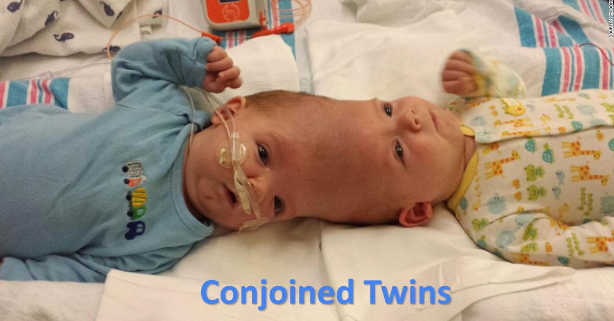 Anesthesia Recommendations for Conjoined Twins