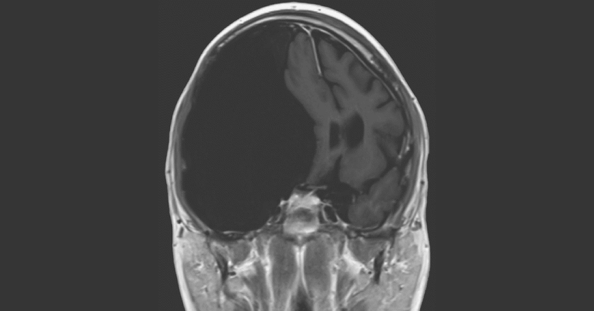 A Young Man With Frequent Headaches And Falls