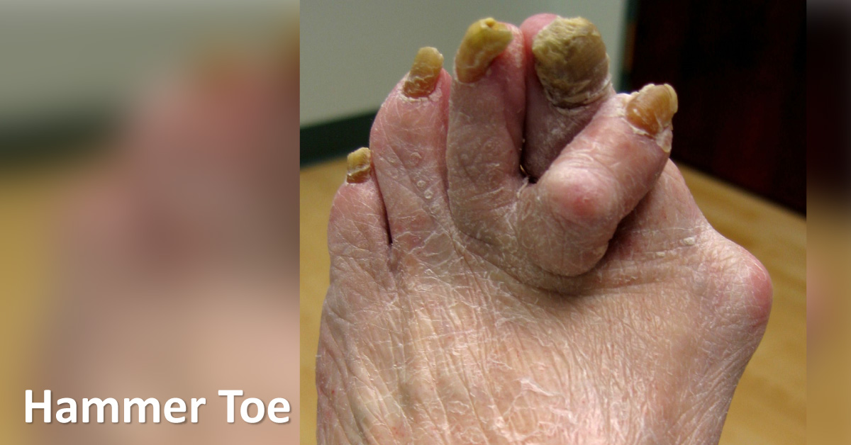 Surgical Management Of Hammer Toe