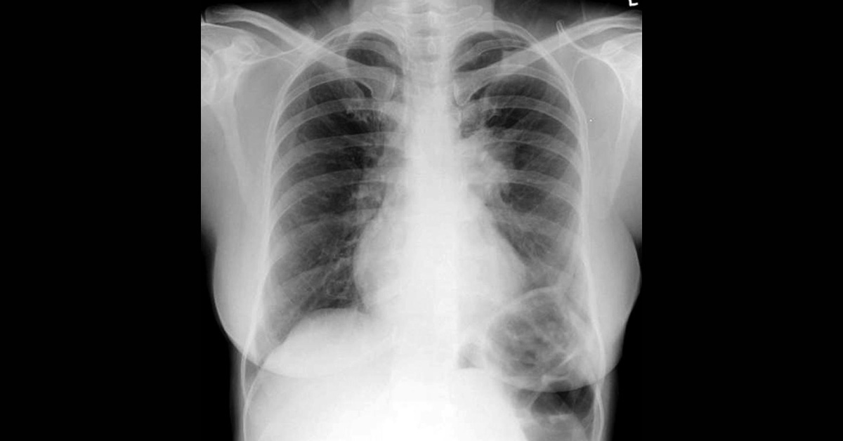 Allergic Bronchopulmonary Aspergillosis, An Insight